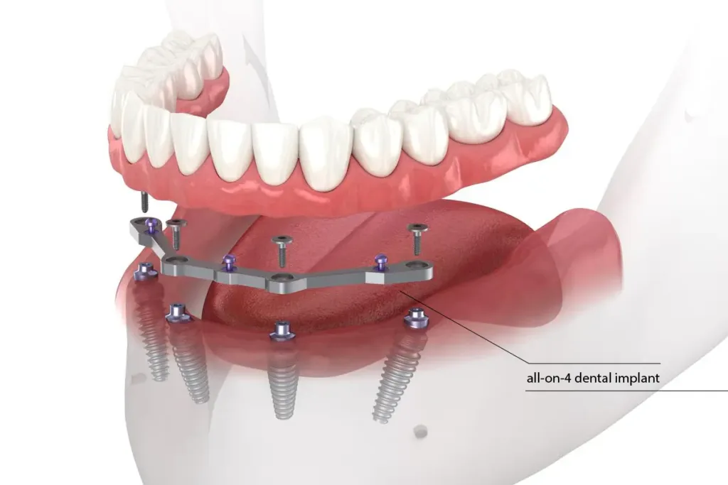 All In-4 Dental Implant Kr Puram Img
