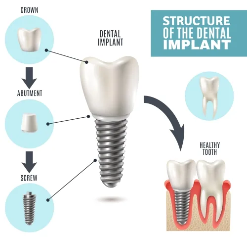dental-implant-img.jpg